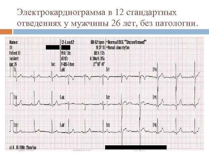 Электрокардиограмма в 12 стандартных отведениях у мужчины 26 лет, без патологии. 