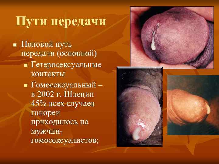 Пути передачи n Половой путь передачи (основной) n Гетеросексуальные контакты n Гомосексуальный – в