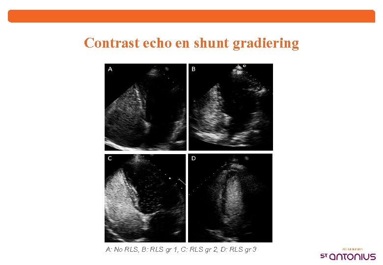 Contrast echo en shunt gradiering A: No RLS, B: RLS gr 1, C: RLS