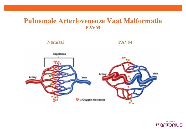 Pulmonale Arterioveneuze Vaat Malformatie -PAVMNormaal PAVM 
