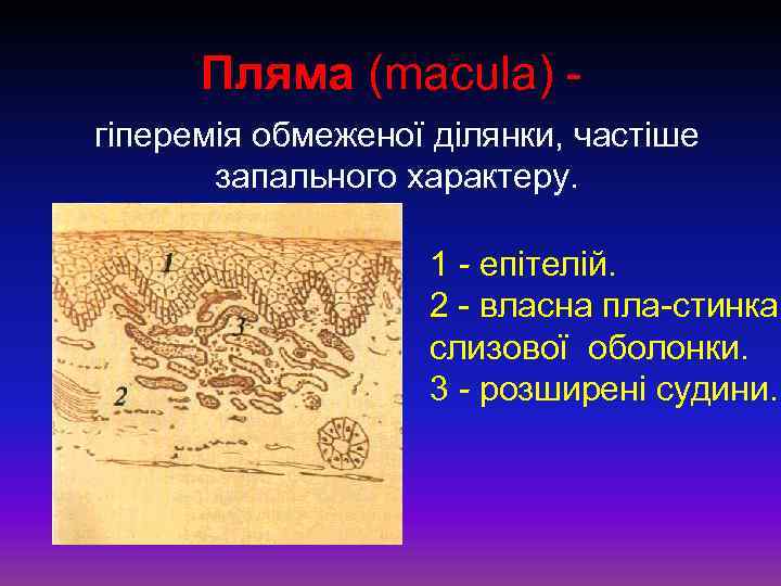 Пляма (macula) гіперемія обмеженої ділянки, частіше запального характеру. 1 - епітелій. 2 власна пла