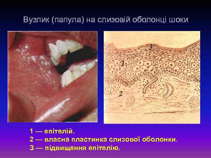Вузлик (папула) на слизовій оболонці шоки 1 — епітелій. 2 — власна пластинка слизової
