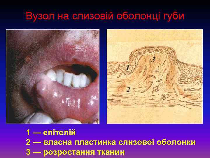 Вузол на слизовій оболонці губи 1 — епітелій 2 — власна пластинка слизової оболонки