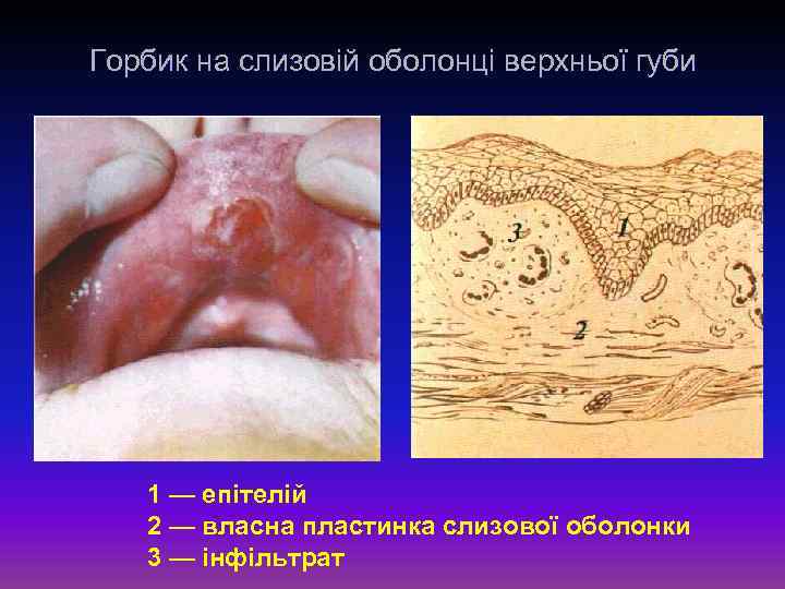 Горбик на слизовій оболонці верхньої губи 1 — епітелій 2 — власна пластинка слизової