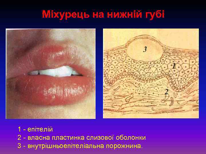 Міхурець на нижній губі 1 - епітелій 2 - власна пластинка слизової оболонки 3