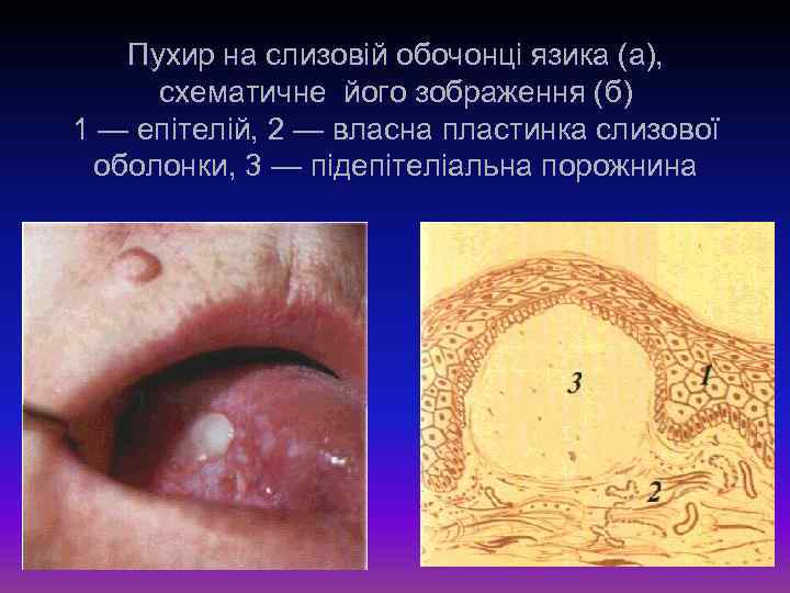 Пухир на слизовій обочонці язика (а), схематичне його зображення (б) 1 — епітелій, 2