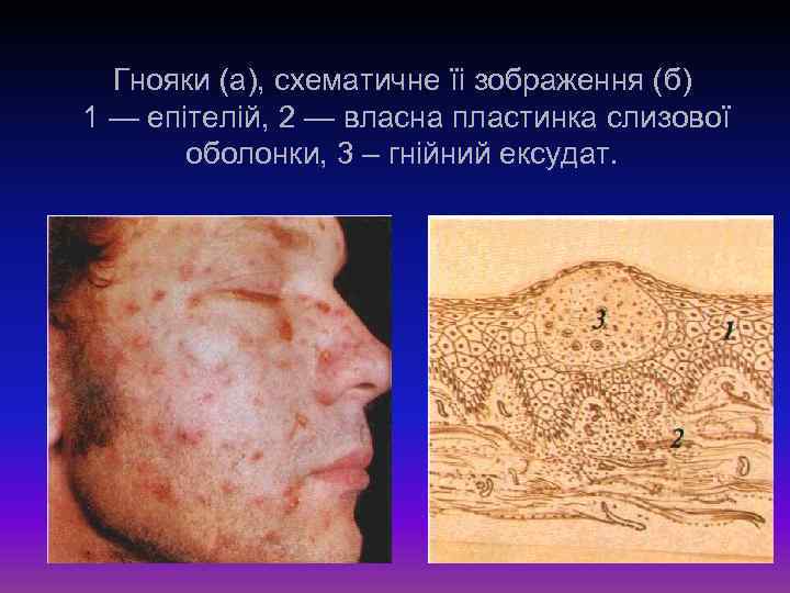 Гнояки (а), схематичне їі зображення (б) 1 — епітелій, 2 — власна пластинка слизової