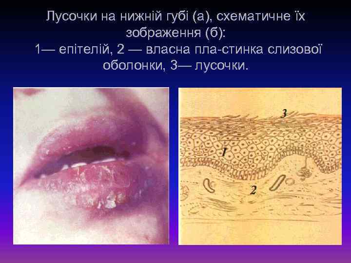 Лусочки на нижній губі (а), схематичне їх зображення (б): 1— епітелій, 2 — власна