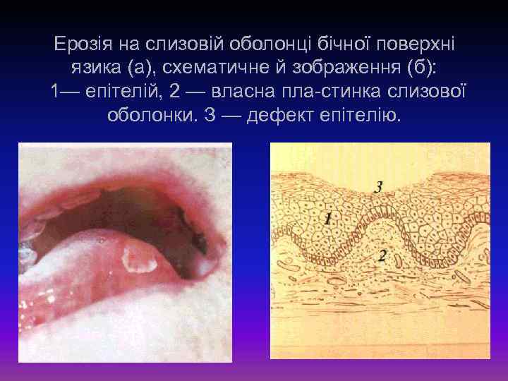Ерозія на слизовій оболонці бічної поверхні язика (а), схематичне й зображення (б): 1— епітелій,
