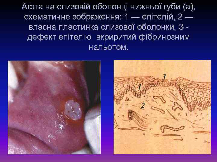 Афта на слизовій оболонці нижньої губи (а), схематичне зображення: 1 — епітелій, 2 —