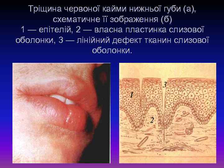 Тріщина червоної кайми нижньої губи (а), схематичне її зображення (б) 1 — епітелій, 2