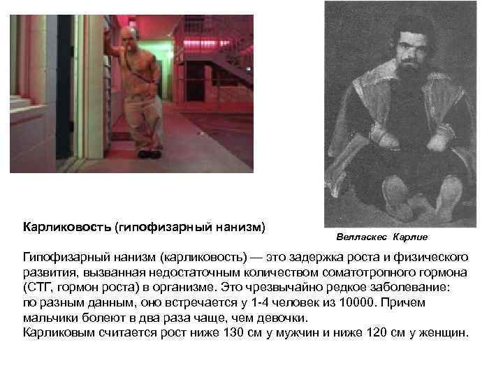Карликовость (гипофизарный нанизм) Велласкес Карлие Гипофизарный нанизм (карликовость) — это задержка роста и физического