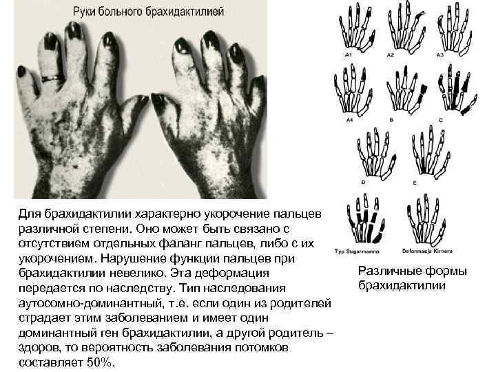 Для брахидактилии характерно укорочение пальцев различной степени. Оно может быть связано с отсутствием отдельных