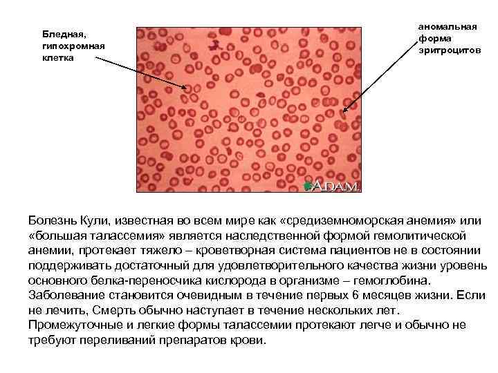 Бледная, гипохромная клетка аномальная форма эритроцитов Болезнь Кули, известная во всем мире как «средиземноморская