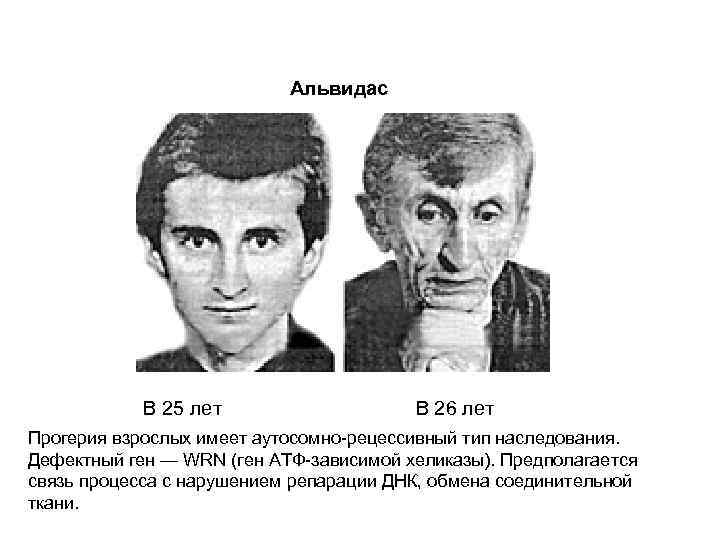 Альвидас В 25 лет В 26 лет Прогерия взрослых имеет аутосомно-рецессивный тип наследования. Дефектный