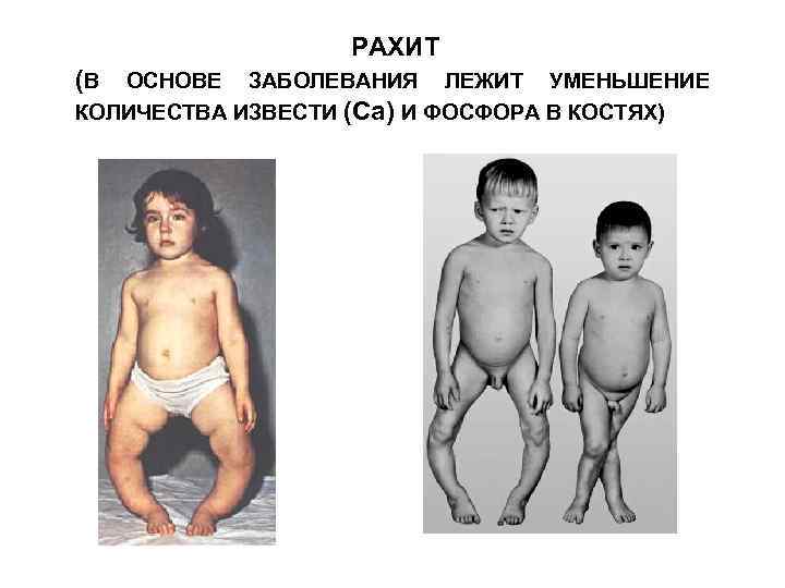 РАХИТ (В ОСНОВЕ ЗАБОЛЕВАНИЯ ЛЕЖИТ УМЕНЬШЕНИЕ КОЛИЧЕСТВА ИЗВЕСТИ (Са) И ФОСФОРА В КОСТЯХ) 