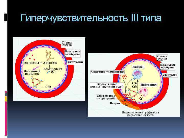 Гиперчувствительность III типа 