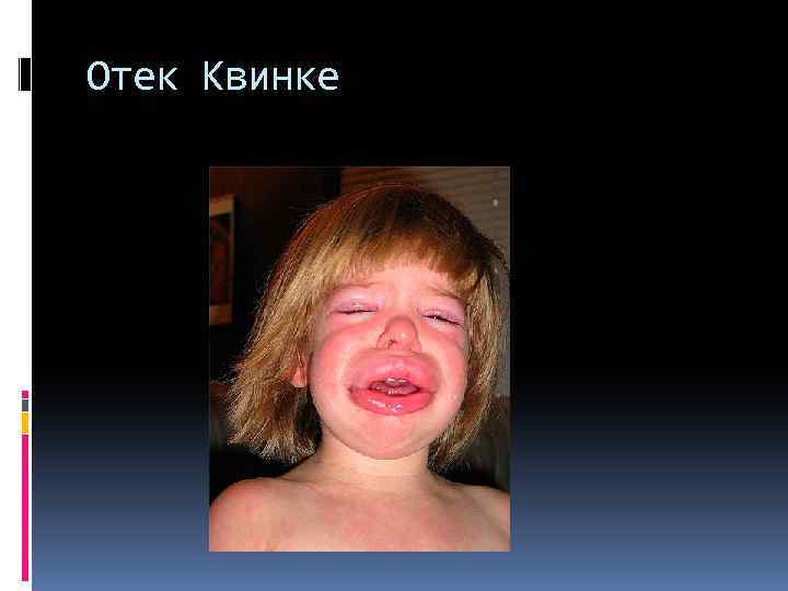 Отек Квинке 