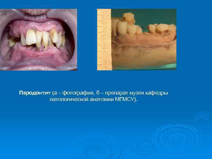 Презентация болезни пародонта