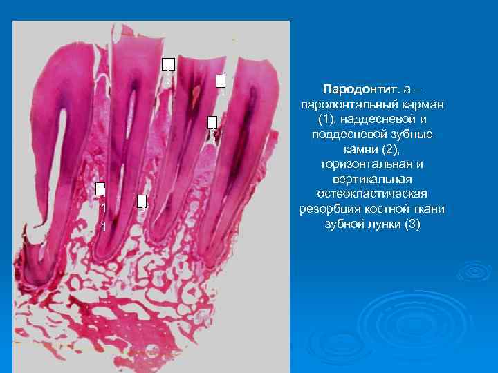 2 2 2 1 1 1 3 Пародонтит. а – пародонтальный карман (1), наддесневой