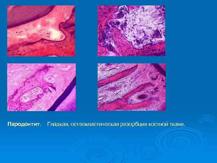 Пародонтит. Гладкая, остеокластическая резорбция костной ткани. 