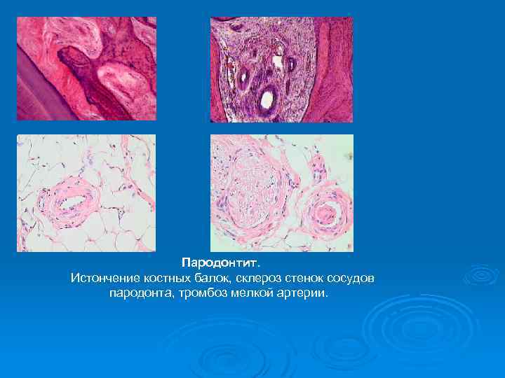 Пародонтит. Истончение костных балок, склероз стенок сосудов пародонта, тромбоз мелкой артерии. 