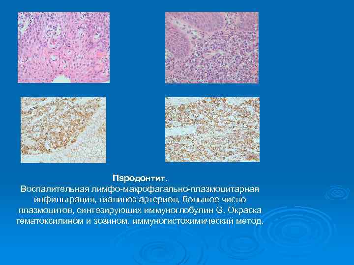 Пародонтит. Воспалительная лимфо-макрофагально-плазмоцитарная инфильтрация, гиалиноз артериол, большое число плазмоцитов, синтезирующих иммуноглобулин G. Окраска гематоксилином