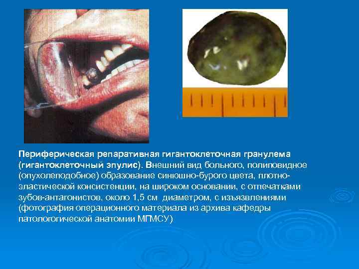 Периферическая репаративная гигантоклеточная гранулема (гигантоклеточный эпулис). Внешний вид больного, полиповидное (опухолеподобное) образование синюшно-бурого цвета,