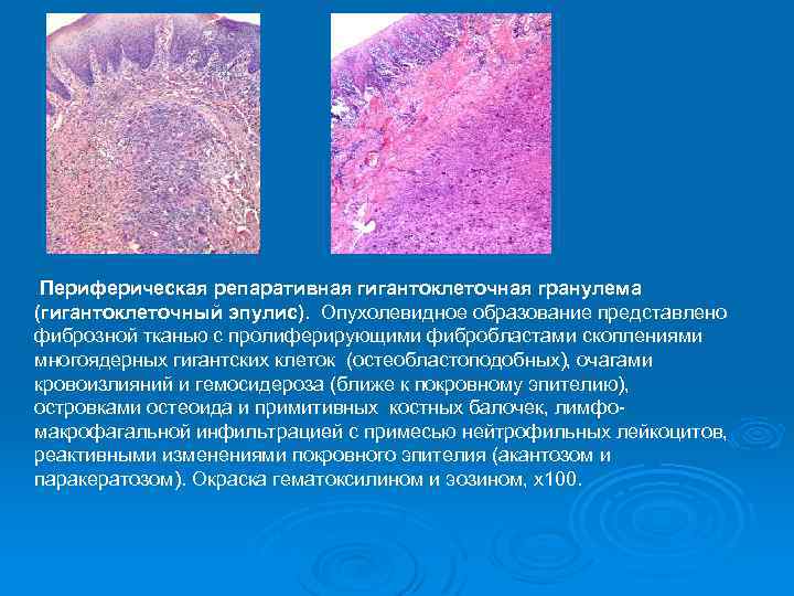 Для рентгенологической картины кистозной формы гигантоклеточной опухоли характерно