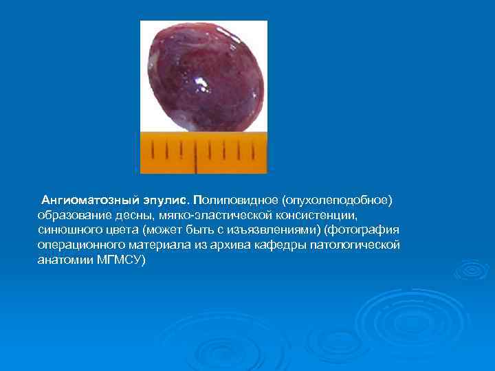 Ангиоматозный эпулис. Полиповидное (опухолеподобное) образование десны, мягко-эластической консистенции, синюшного цвета (может быть с изъязвлениями)