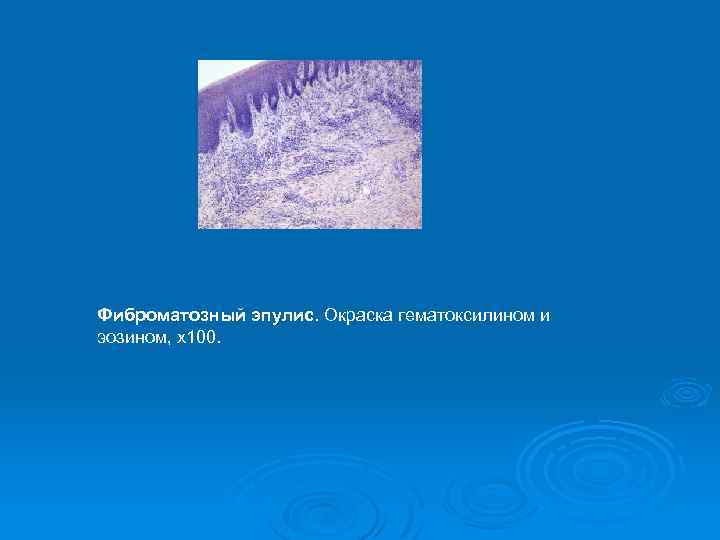 Фиброматозный эпулис. Окраска гематоксилином и эозином, х100. 