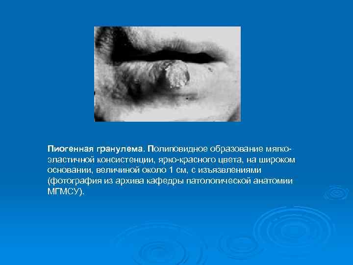 Пиогенная гранулема. Полиповидное образование мягкоэластичной консистенции, ярко-красного цвета, на широком основании, величиной около 1