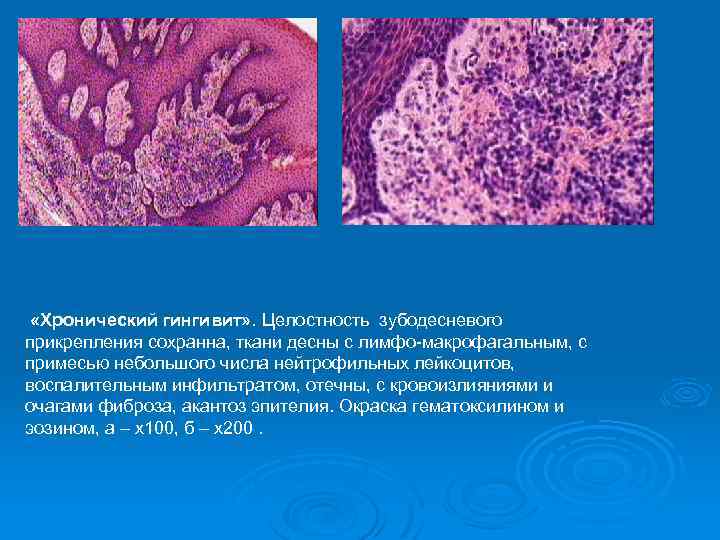  «Хронический гингивит» . Целостность зубодесневого прикрепления сохранна, ткани десны с лимфо-макрофагальным, с примесью