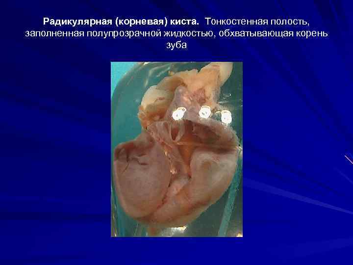 Радикулярная (корневая) киста. Тонкостенная полость, заполненная полупрозрачной жидкостью, обхватывающая корень зуба 