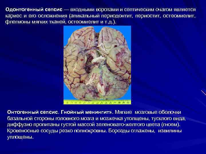 Одонтогенный сепсис — входными воротами и септическим очагом является кариес и его осложнения (апикальный