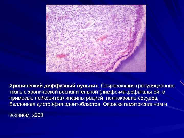 Хронический диффузный пульпит. Созревающая грануляционная ткань с хронической воспалительной (лимфо-макрофагальной, с примесью лейкоцитов) инфильтрацией,