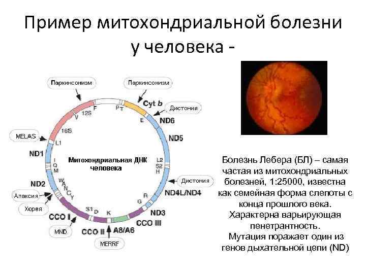 Пример митохондриальной болезни у человека - Болезнь Лебера (БЛ) – самая частая из митохондриальных