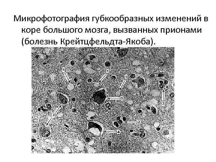 Цитологическая картина атрофического кольпита