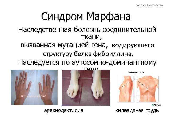 Наследственные болезни Синдром Марфана Наследственная болезнь соединительной ткани, вызванная мутацией гена, кодирующего структуру белка