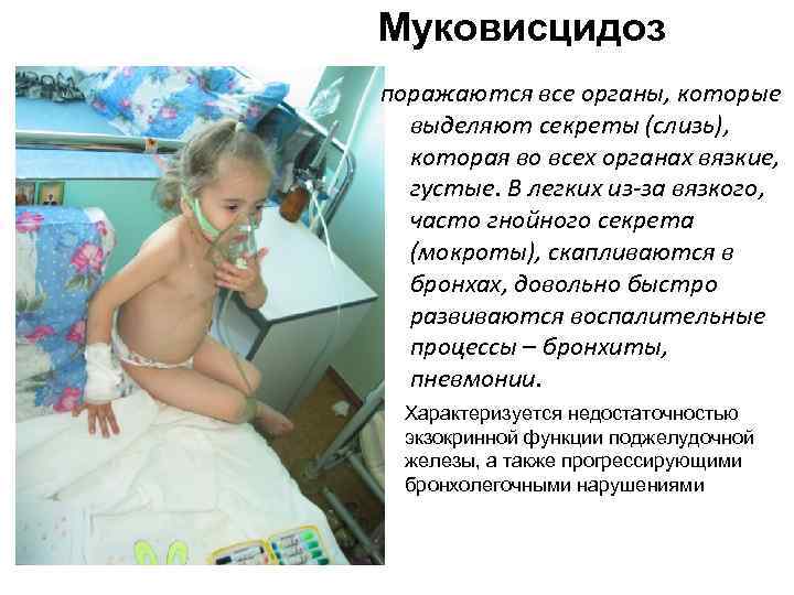 Муковисцидоз поражаются все органы, которые выделяют секреты (слизь), которая во всех органах вязкие, густые.