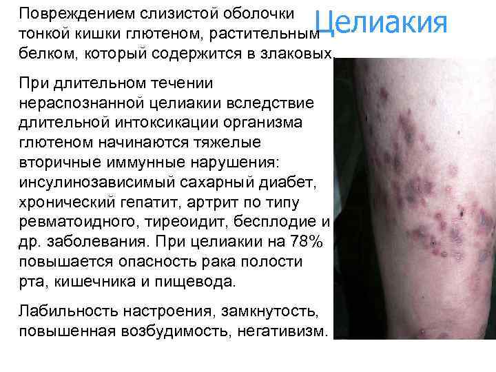 Целиакия Повреждением слизистой оболочки тонкой кишки глютеном, растительным белком, который содержится в злаковых. При