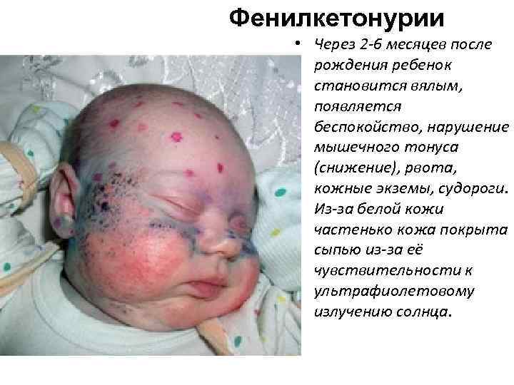 Фенилкетонурии • Через 2 -6 месяцев после рождения ребенок становится вялым, появляется беспокойство, нарушение