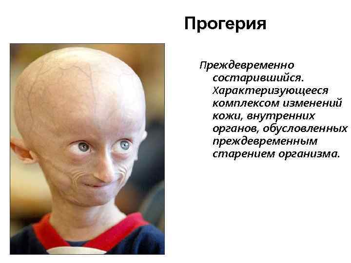 Прогерия Преждевременно состарившийся. Характеризующееся комплексом изменений кожи, внутренних органов, обусловленных преждевременным старением организма. 