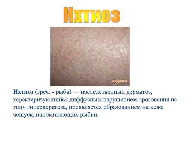 Ихтиоз (греч. - рыба) — наследственный дерматоз, характеризующийся диффузным нарушением ороговения по типу гиперкератоза,