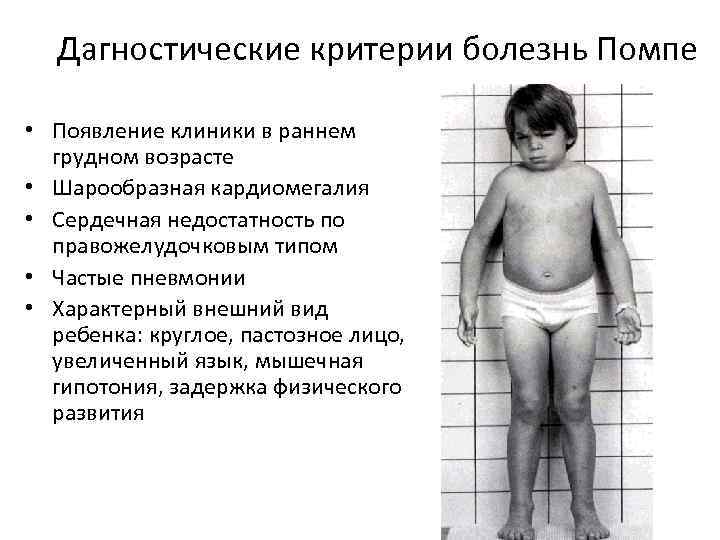 Дагностические критерии болезнь Помпе • Появление клиники в раннем грудном возрасте • Шарообразная кардиомегалия