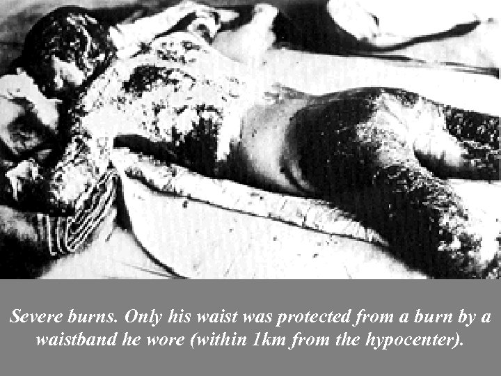 Severe burns. Only his waist was protected from a burn by a waistband he