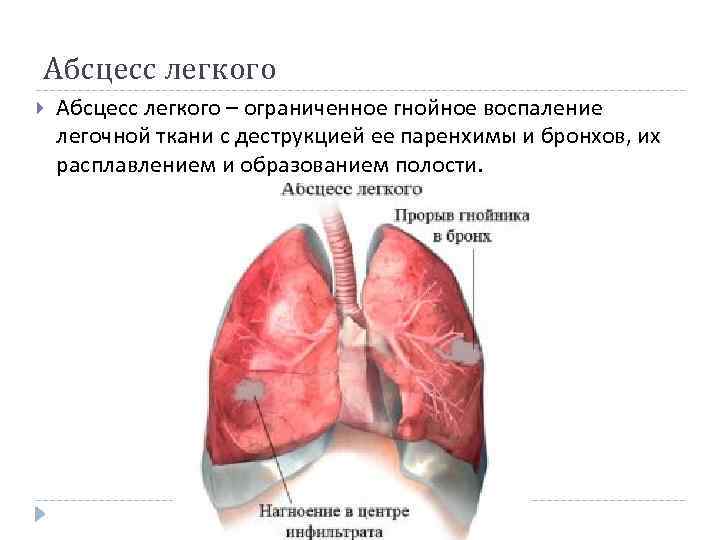 Абсцесс легкого – ограниченное гнойное воспаление легочной ткани с деструкцией ее паренхимы и бронхов,