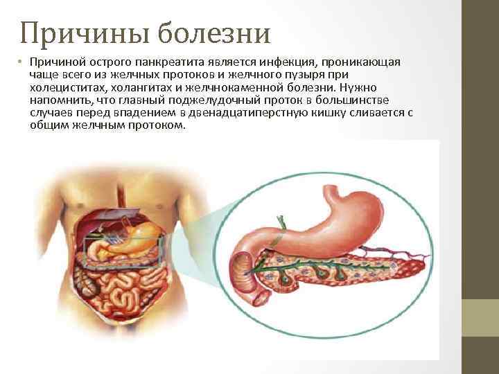 Причины болезни • Причиной острого панкреатита является инфекция, проникающая чаще всего из желчных протоков