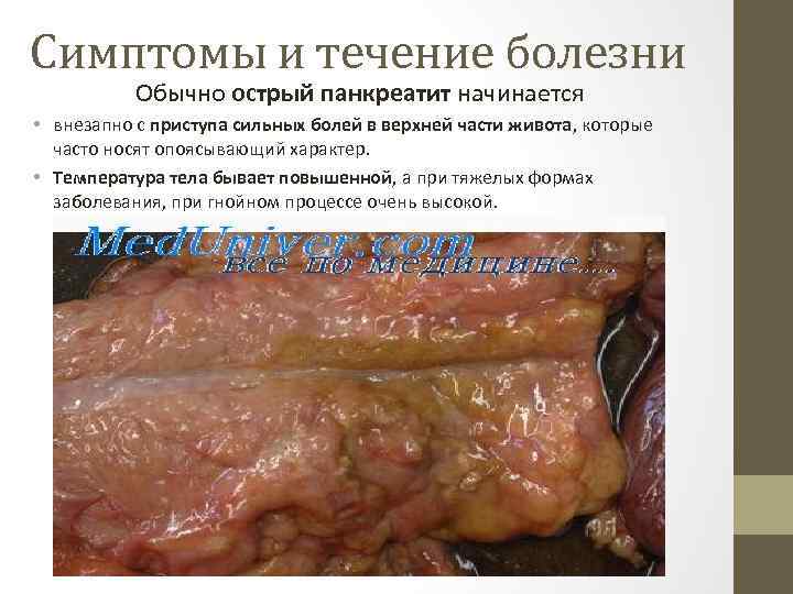 Симптомы и течение болезни Обычно острый панкреатит начинается • внезапно с приступа сильных болей