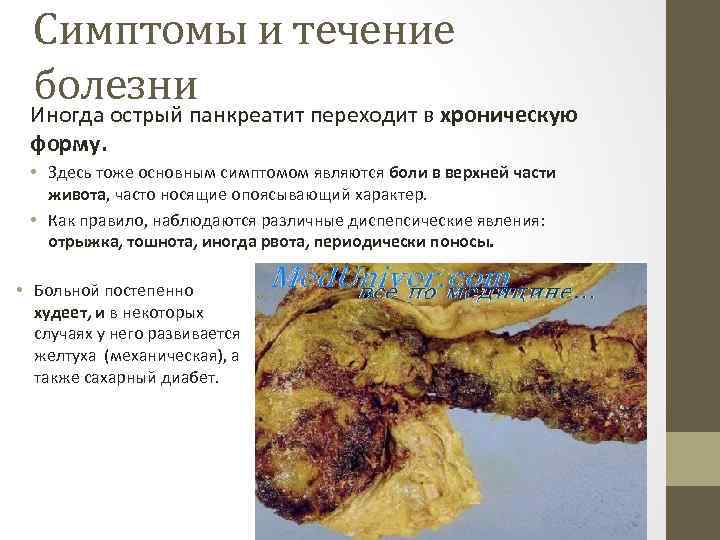 Симптомы и течение болезни Иногда острый панкреатит переходит в хроническую форму. • Здесь тоже